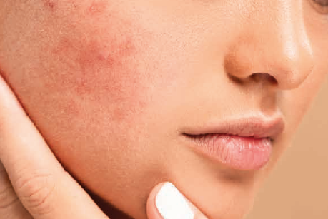 Nanoformulacje jako innowacyjna forma preparatów stosowanych w regeneracji i leczeniu stanów zapalnych skóry